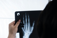 Liječnici imaju isti odgovor na čudnu teoriju o ljudima koji nikada nisu slomili kost