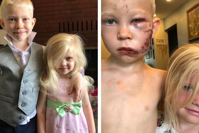 Dječak junak: Spasio sestru od napada psa, dobio 90 šavova na licu