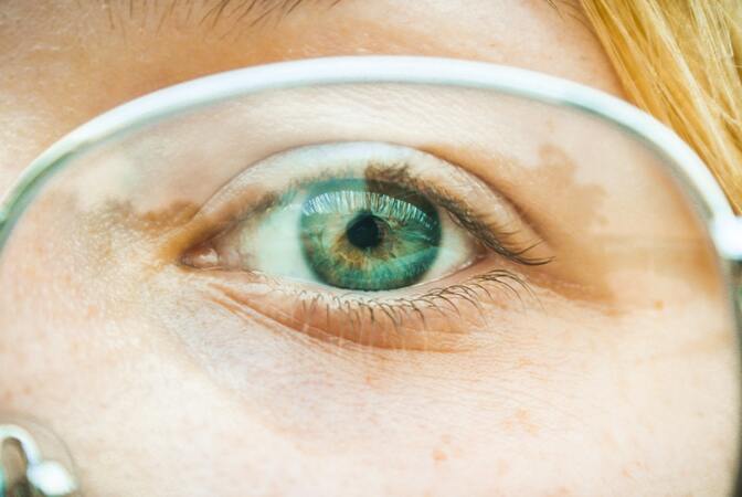 Kako se liječi astigmatizam?